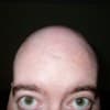 Funny holidays - International Alopecia Day